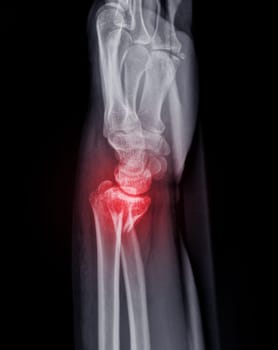 X-ray image of Left wrist joint AP and Lateral view for showing fracture of radius bone.