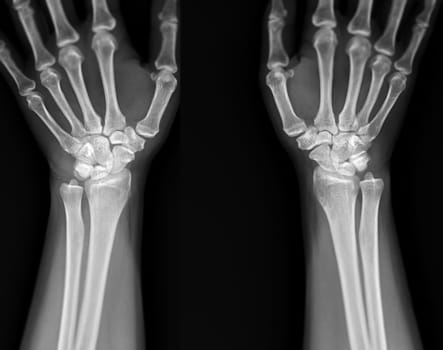 X-ray image of wrist joint front view of normal wrist joint.