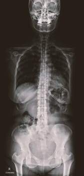 X-ray image of Whole Spine for diagnosis scoliosis of spine.