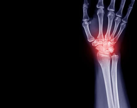 X-ray image of wrist joint front view of normal wrist joint.