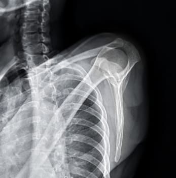 X-ray Shoulder joint shoulder transcapular view for diagnosis fracture of shoulder joint.