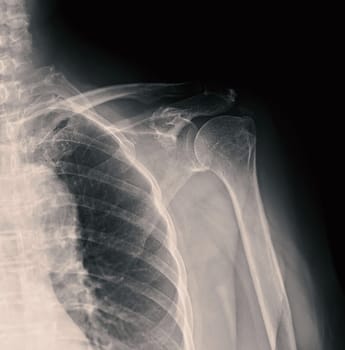 X-ray Shoulder joint shoulder front view for diagnosis fracture of shoulder joint.