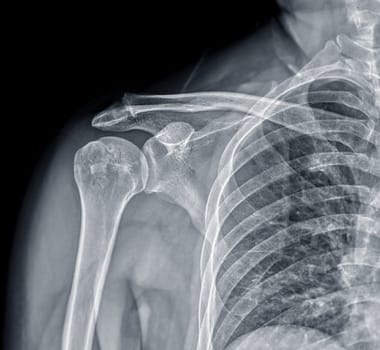 X-ray Shoulder joint shoulder front view for diagnosis fracture of shoulder joint.