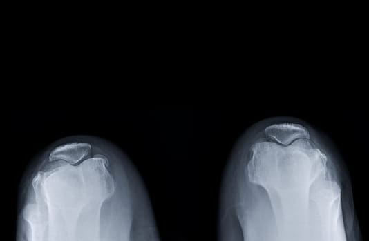 X-ray image of both Normal patella .