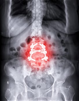 X-ray image of Lumbar spine showing pedicle screw fixation and decompression surgery in patient with spinal canal stenosis.