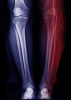 X-ray image of leg Fusion with CTA Femoral run off .