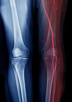 X-ray image of knee joint Fusion with CTA Femoral run off .