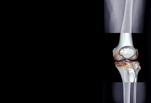 Film x-ray of knee joint AP view fusion with 3D rendering knee joint for medical background.