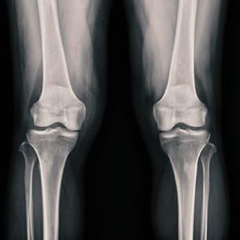 Film x-ray both knee joint AP view showing normal knee joint.