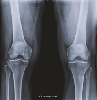 Film x-ray both knee joint AP view name is Rosenberg view for diagnosis knee pain from osteoarthritis knee and fracture .