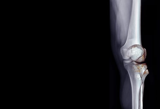 Film x-ray of knee joint AP view fusion with 3D rendering knee joint for medical background.