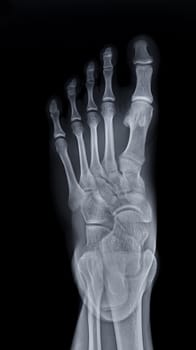 Foot x-ray image AP view isolated on black background.