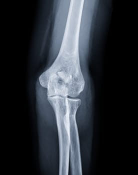 X-ray of Elbow join showing fracture of ulna bone.