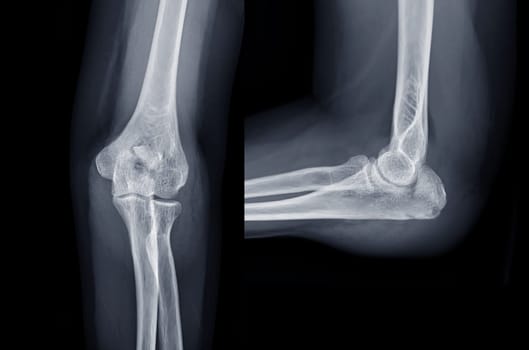 X-ray of Elbow join showing fracture of ulna bone.