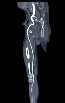 CTA femoral artery run off MPR curve showing Right femoral artery for diagnostic Acute or Chronic Peripheral Arterial Disease.