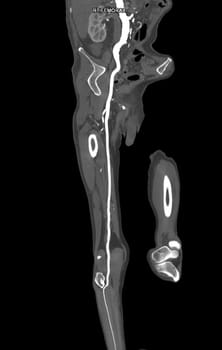 CTA femoral artery run off MPR curve showing Right femoral artery for diagnostic Acute or Chronic Peripheral Arterial Disease.