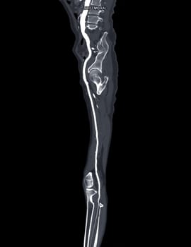 CTA femoral artery run off MPR curve showing Left femoral artery for diagnostic Acute or Chronic Peripheral Arterial Disease.