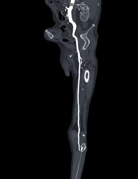 CTA femoral artery run off MPR curve showing Left femoral artery for diagnostic Acute or Chronic Peripheral Arterial Disease.