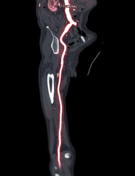 CTA femoral artery run off MPR curve showing Left femoral artery for diagnostic Acute or Chronic Peripheral Arterial Disease.