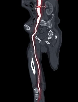 CTA femoral artery run off MPR curve showing Left femoral artery for diagnostic Acute or Chronic Peripheral Arterial Disease.