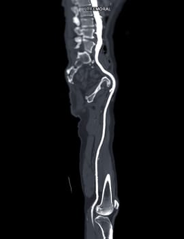 CTA femoral artery run off MPR curve showing Left femoral artery for diagnostic Acute or Chronic Peripheral Arterial Disease.