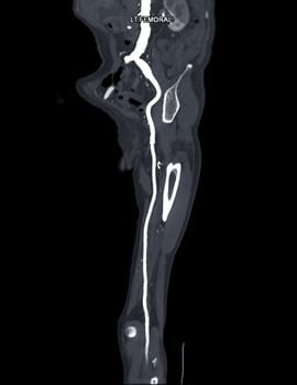 CTA femoral artery run off MPR curve showing Left femoral artery for diagnostic Acute or Chronic Peripheral Arterial Disease.