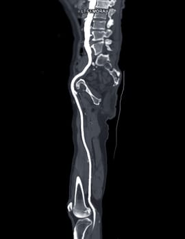 CTA femoral artery run off MPR curve showing Left femoral artery for diagnostic Acute or Chronic Peripheral Arterial Disease.