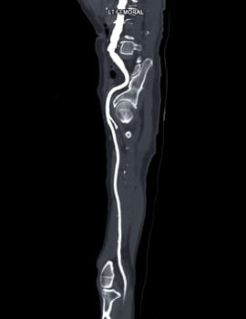 CTA femoral artery run off MPR curve showing Left femoral artery for diagnostic Acute or Chronic Peripheral Arterial Disease.