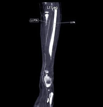 CTA femoral artery run off MPR curve showing Left femoral artery for diagnostic Acute or Chronic Peripheral Arterial Disease.