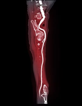 CTA femoral artery run off MPR curve showing Left femoral artery for diagnostic Acute or Chronic Peripheral Arterial Disease.