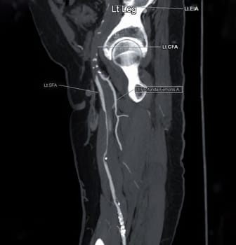 CTA femoral artery run off MPR curve showing Left femoral artery for diagnostic Acute or Chronic Peripheral Arterial Disease.