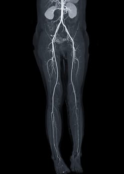 CTA femoral artery run off showing femoral artery for diagnostic Acute or Chronic Peripheral Arterial Disease.