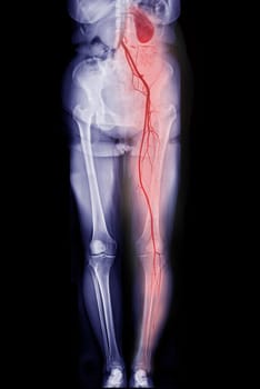 CTA femoral artery run off showing femoral artery for diagnostic Acute or Chronic Peripheral Arterial Disease.