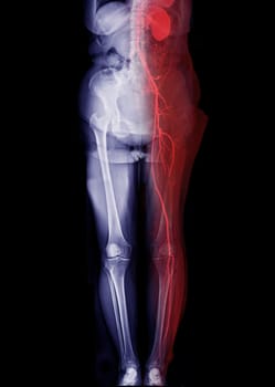 CTA femoral artery run off showing femoral artery for diagnostic Acute or Chronic Peripheral Arterial Disease.