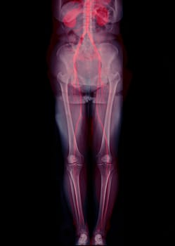 CTA femoral artery run off showing femoral artery for diagnostic Acute or Chronic Peripheral Arterial Disease.