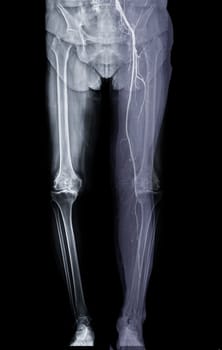 Scanogram image fusion with CTA lower extremities.