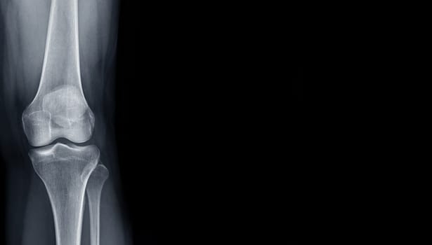 Film x-ray of Left knee joint AP view for medical background.