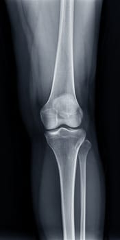 Film x-ray of Left knee joint AP view for diagnosis knee pain from osteoarthritis knee and fracture .