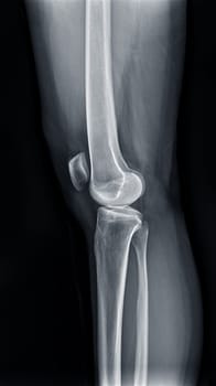 Film x-ray of Left knee joint Lateral view for diagnosis knee pain from osteoarthritis knee and fracture .