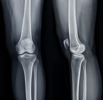 Film x-ray of Left knee joint AP and Lateral view for diagnosis knee pain from osteoarthritis knee and fracture .