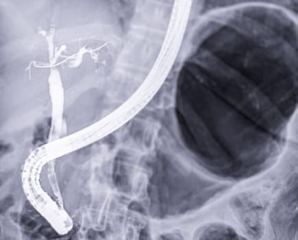 X-ray image of endoscopic after Doctor doing ERCP and laparoscopic cholecystectomy inside modern operating room.