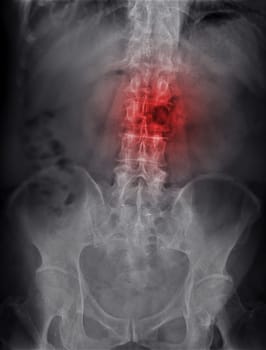 X-ray image of lambosacral spine or L-S spine showing lesion at L3.