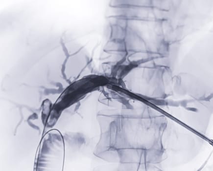 X-ray image of portal vein after Doctor doing ERCP and laparoscopic cholecystectomy inside modern operating room.