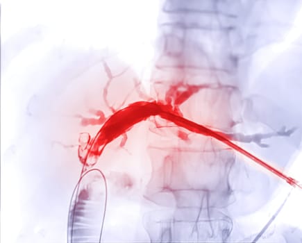 X-ray image of portal vein after Doctor doing ERCP and laparoscopic cholecystectomy inside modern operating room.