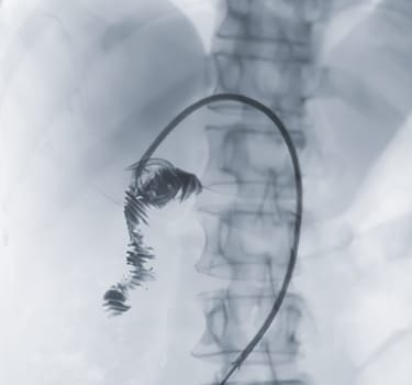 X-ray image of portal vein after Doctor doing ERCP and laparoscopic cholecystectomy inside modern operating room.