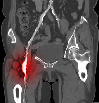 CTA femoral artery run off MPR curve showing Left femoral artery for diagnostic Acute or Chronic Peripheral Arterial Disease.
