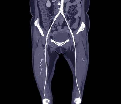 CTA femoral artery run off MPR curve showing Left femoral artery for diagnostic Acute or Chronic Peripheral Arterial Disease.