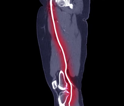 CTA femoral artery run off MPR curve showing Left femoral artery for diagnostic Acute or Chronic Peripheral Arterial Disease.