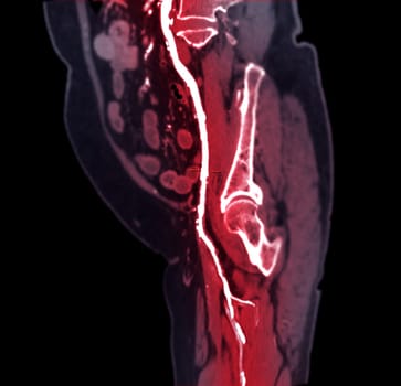 CTA femoral artery run off MPR curve showing Left femoral artery for diagnostic Acute or Chronic Peripheral Arterial Disease.