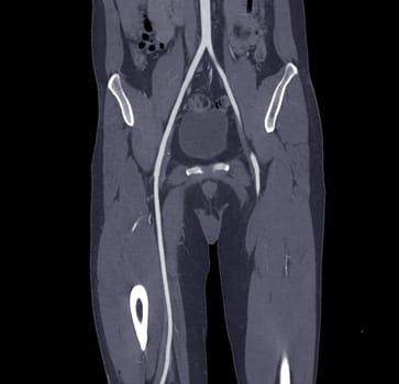 CTA femoral artery run off MPR curve showing Left femoral artery for diagnostic Acute or Chronic Peripheral Arterial Disease.